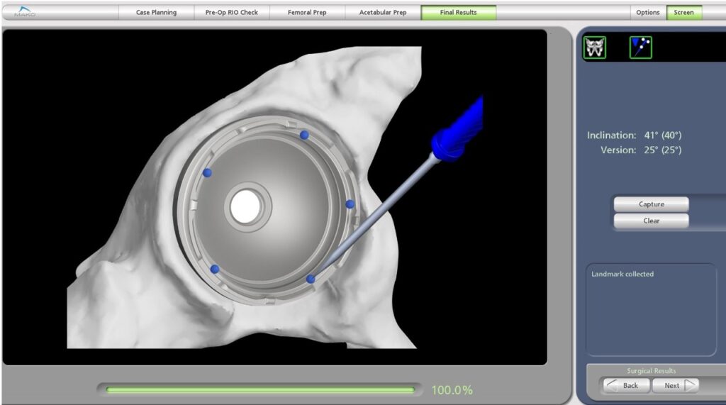 robotic hip replacement surgery in Hyderabad