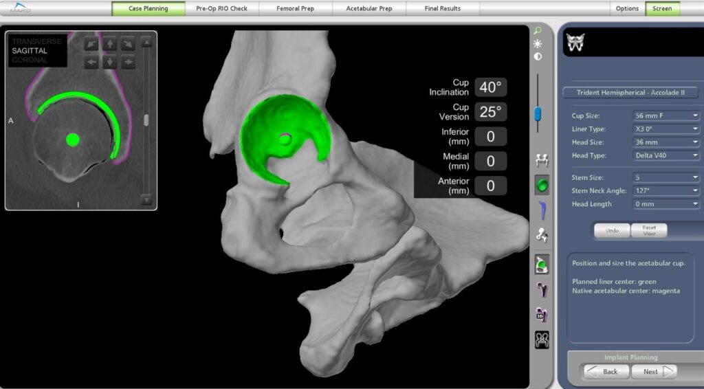 robotic hip replacement in Hyderabad