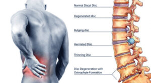 Types of back pain