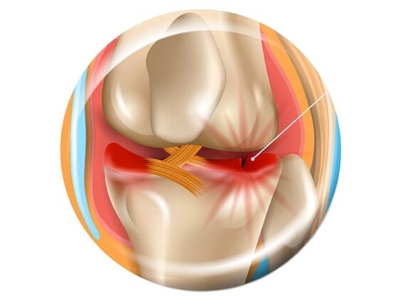 meniscus tear treatment in Hyderabad