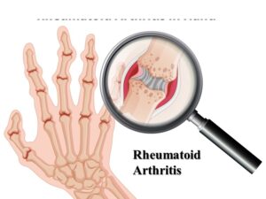 Rheumatoid arthritis