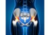 Hip Pain – Causes, Symptoms, Diagnosis & Treatment