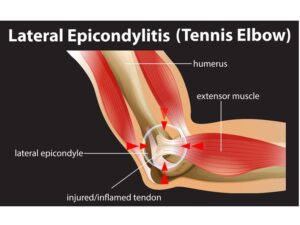 tennis elbow treatment in Hyderabad