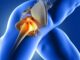 Hip Fractures Types, Treatment and Recovery