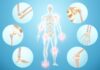 PAGET DISEASE OF BONE – Pain, Arthritis & Bone Fractures