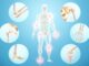 PAGET DISEASE OF BONE – Pain, Arthritis & Bone Fractures