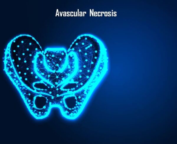 Avascular necrosis causes