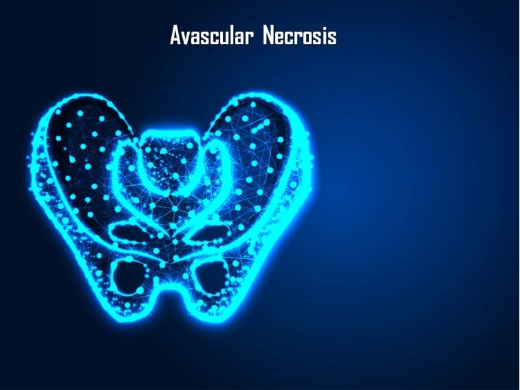 Avascular necrosis causes