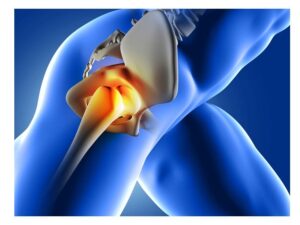 Osteoarthritis of the hip