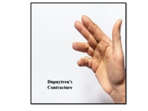 Dupuytren Contracture