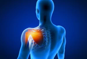 Frozen shoulder treatment in Hyderabad
