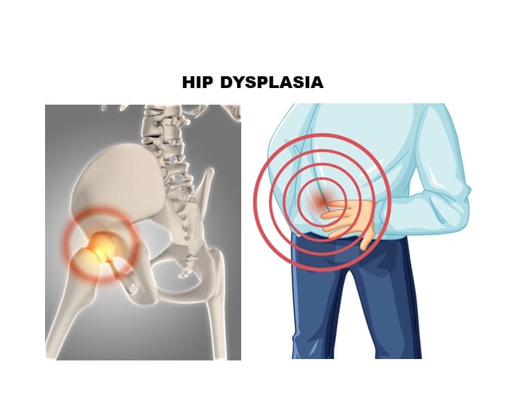 hip dysplasia causes