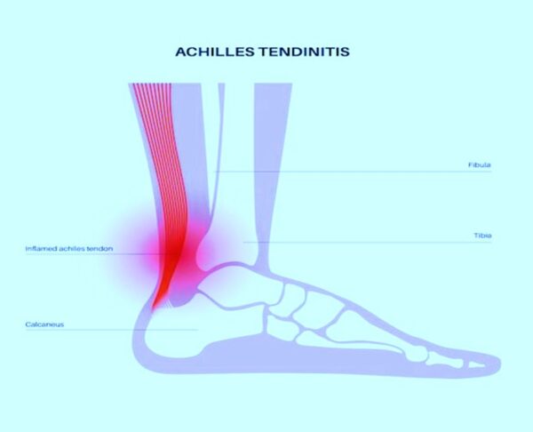 Achilles Tendinitis Types, Symptoms & Treatment