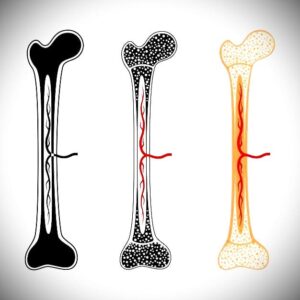 osteomalacia treatment