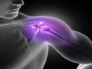 shoulder-impingement-syndrome